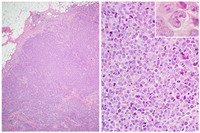 ALCL, ALK-; TP63 rearranged