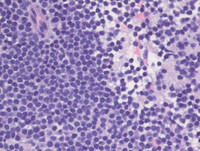 Myeloma-with-Cyclin-D1