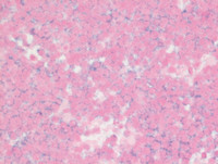 Myeloma-with-Cyclin-D1