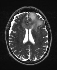 MDS-RS-MLD in staging marrow for PCNSL