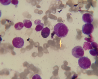 ALL patient taking G-CSF medication shows a myeloproliferative bone marrow 3