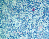 NLPHL-with-progression