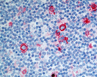 NLPHL-with-progression