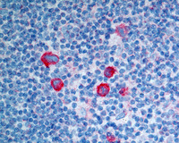 NLPHL-with-progression