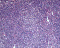 NLPHL-with-progression