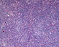 NLPHL-with-progression