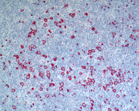 NLPHL-with-progression