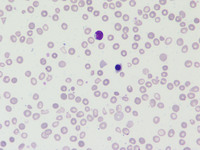 Thalassemia major in a child