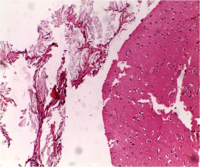 Oxalate crystals in brain