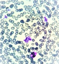 Pseudothrombocytopenia