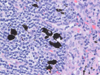 Anthracotic macrophages