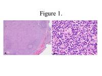 Systemic EBV-positive T-cell Lymphoma