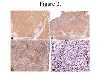 Figure-2-Immunohistochemistry-studies-showing-the-atypical-lymphocytes-are-positive-for-A-CD2-B-CD3-C-CD7-D-with-fewer-cells-positive-for-CD5