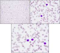 Hairy cell Leukemia (HCL)