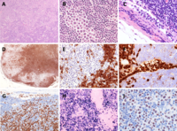 Nodal extracavitary variant of primary effusion lymphoma as complication of chronic lymphocytic leukemia: a previously unreported type of Richter’s sy