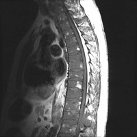 MRI-myeloma