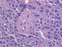 Cutaneous myeloma-High power- H & E