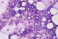 AML with recurrent t(3;3)(q21;q26.2) translocation