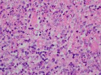 Kikuchi-Fujimoto Disease H&E High Power