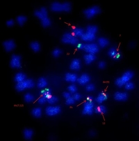 Metaphase FISH image using BCR/ABL1 dual colour dual fusion probe+ Centromere enumeration probe for chromosome 12+ del(7q) triple colour deletion prob