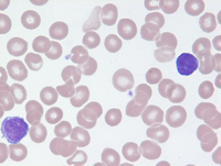 Mycosis-Fungoides-Blood