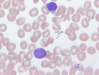 Mycosis-Fungoides-Blood