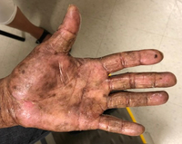 Mycosis-Fungoides-Clincal-Images