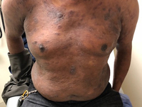 Mycosis Fungoides Involving Peripheral Blood