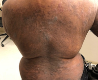 Mycosis-Fungoides-Clincal-Images