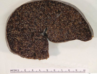 Splenic-Marginal-Zone-LymphomaBlood