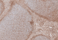 Splenic-Marginal-Zone-LymphomaSpleen