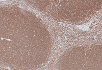 Splenic-Marginal-Zone-LymphomaBlood