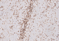 Splenic-Marginal-Zone-LymphomaBlood