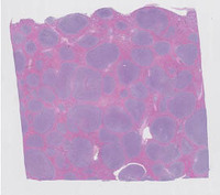 Splenic-Marginal-Zone-LymphomaBlood