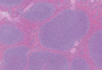 Splenic-Marginal-Zone-LymphomaSpleen