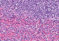 Splenic-Marginal-Zone-LymphomaHE