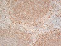 Splenic-Marginal-Zone-LymphomaBlood