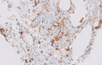 CMLAccelerated-PhaseCD34