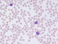 Refractory-Cytopenia-of-Childhood
