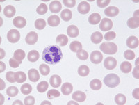 Refractory-Cytopenia-of-Childhood