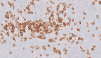 Double-Hit-LymphomaCD3
