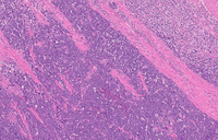 Double-Hit-LymphomaHE-Intermediate-Power