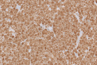 Double-Hit-LymphomaKi67