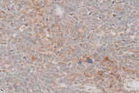 Double-Hit-LymphomaPDL1