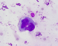 Anaplastic-Large-Cell-Lymphoma-ALK-Aspirate