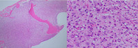 Anaplastic-Large-Cell-Lymphoma-ALK-HE