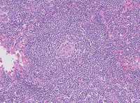 Germinotropic-Lymphoproliferative-DisorderHE