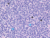 Follicular-Lymphoma-Grade-3aHE