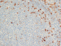 Follicular-Lymphoma-Grade-3aCD10