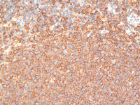 Follicular-Lymphoma-Grade-3aCD20